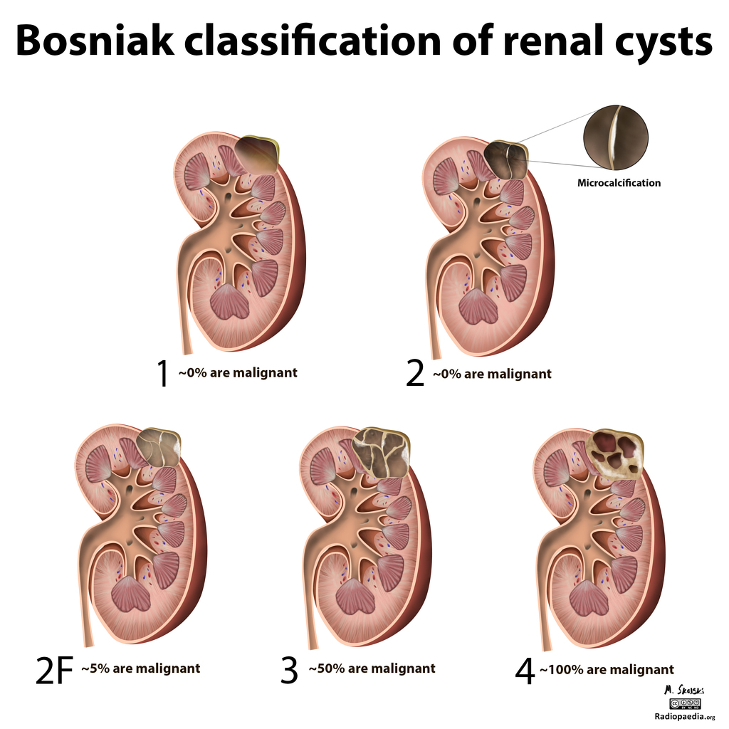 Renal Cyst Archives UCSD Ultrasound Renal Cyst Archives UCSD Ultrasound