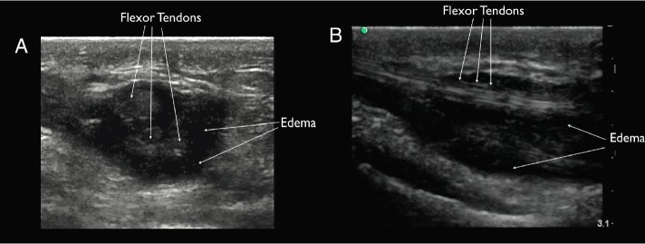 ultrasound flexor tenosynovitis