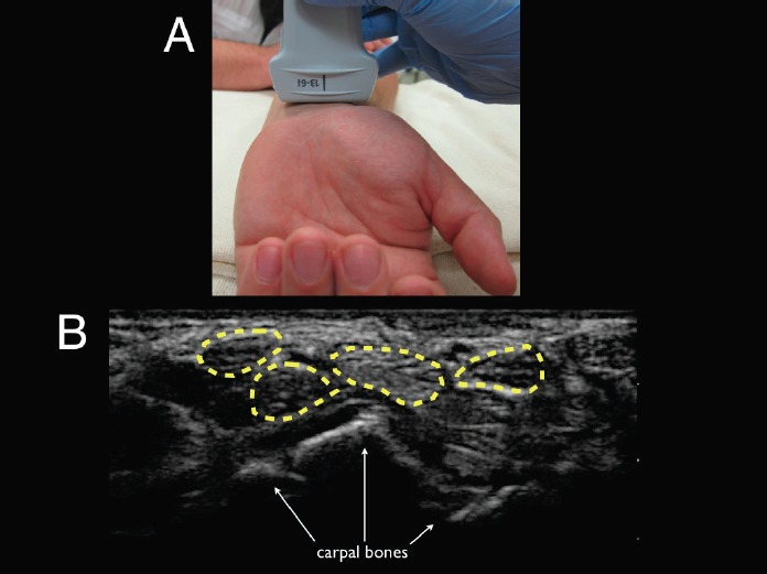 ultrasound flexor tendons