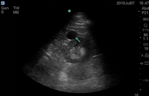 renal cyst ultrasound