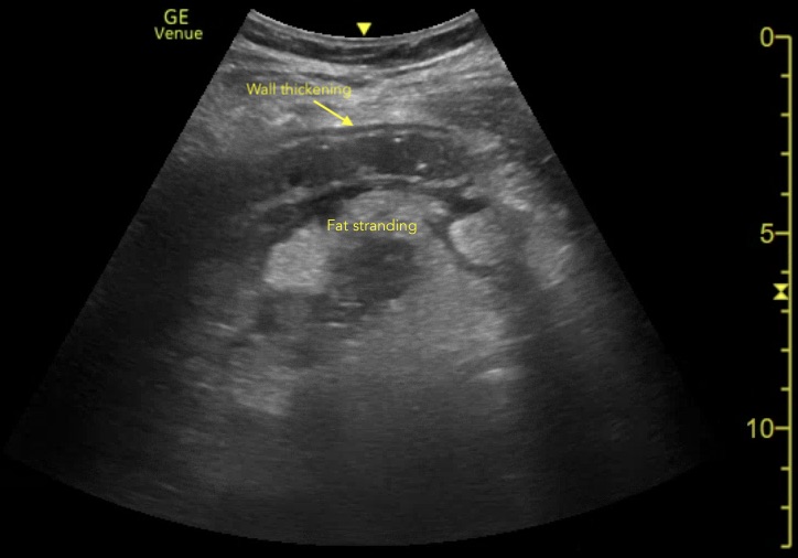 diverticulitis ultrasound