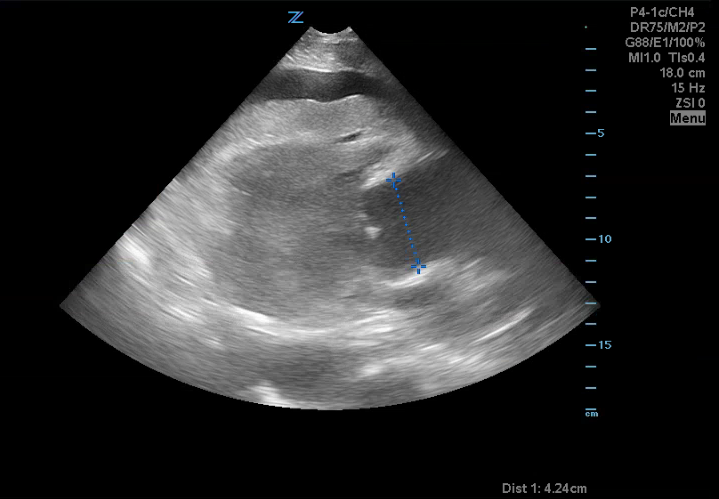 dilated aortic root