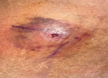 Figure 1: Wound prior to foreign body exploration.