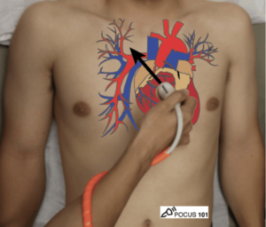 Figure 4: Placement of probe for Parasternal Long Axis view [1].