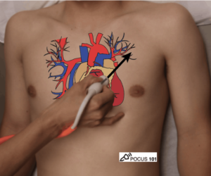 Figure 6: Placement of probe for Parasternal Short Axis view [1].