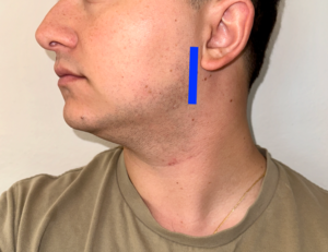 Figure 5: Scan plane used to obtain sagittal view of the parotid