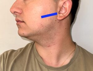 Figure 6: Scan plane used to obtain transverse view of the parotid