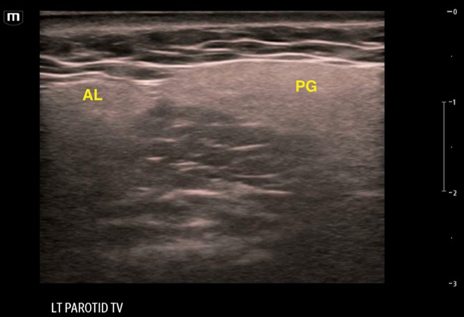 Figure 8: Left parotid gland (PG) with labeled accessory lobe (AL) noted to be just medial and separate from the main gland in the transverse plane